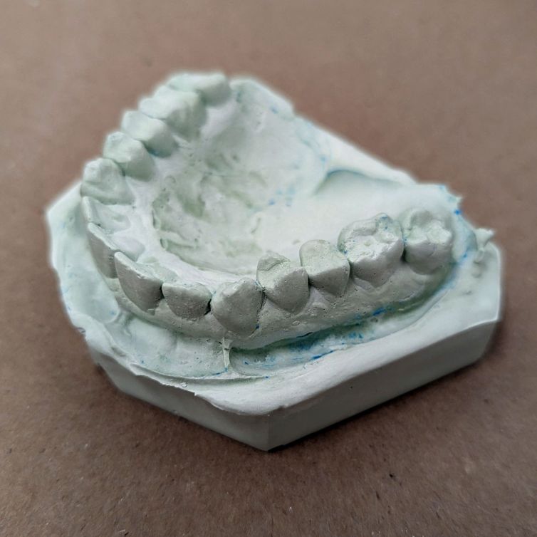 Dental stone upper casting