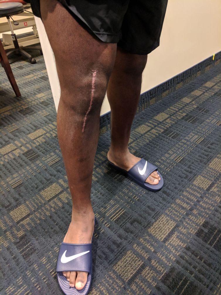 Fake knee surgery scar